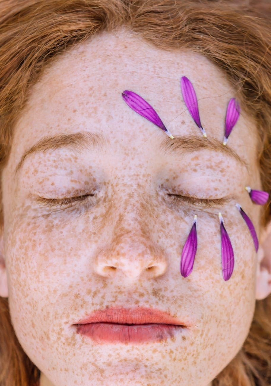 7 ways to get rid of freckles for radiant skin